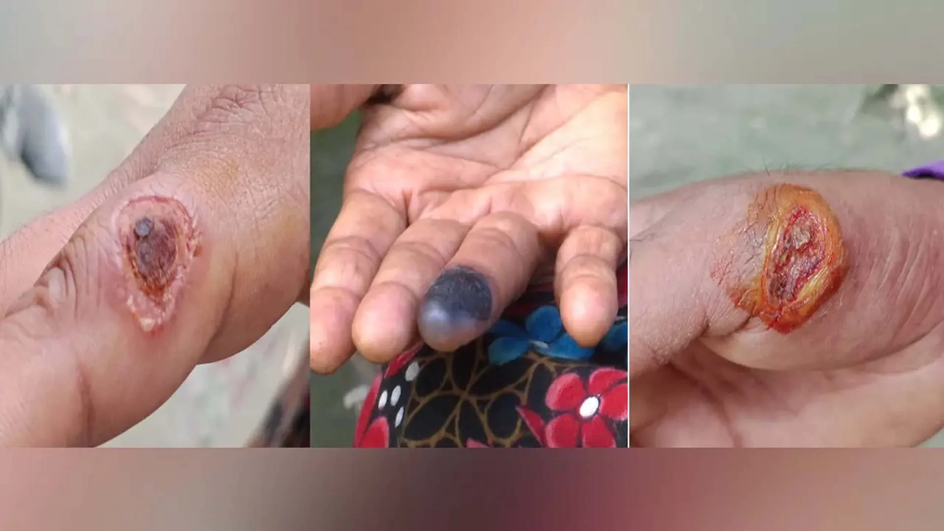 আশঙ্কাজনক হারে ছড়িয়ে পড়ছে পশুবাহিত এক অজানা রোগ